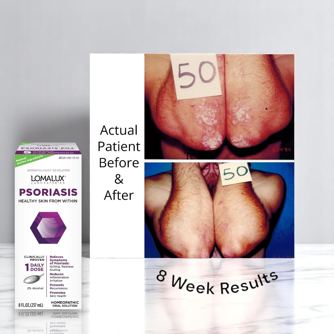 8 oz Psoriasis & Seborrheic Dermatitis Relief N8944